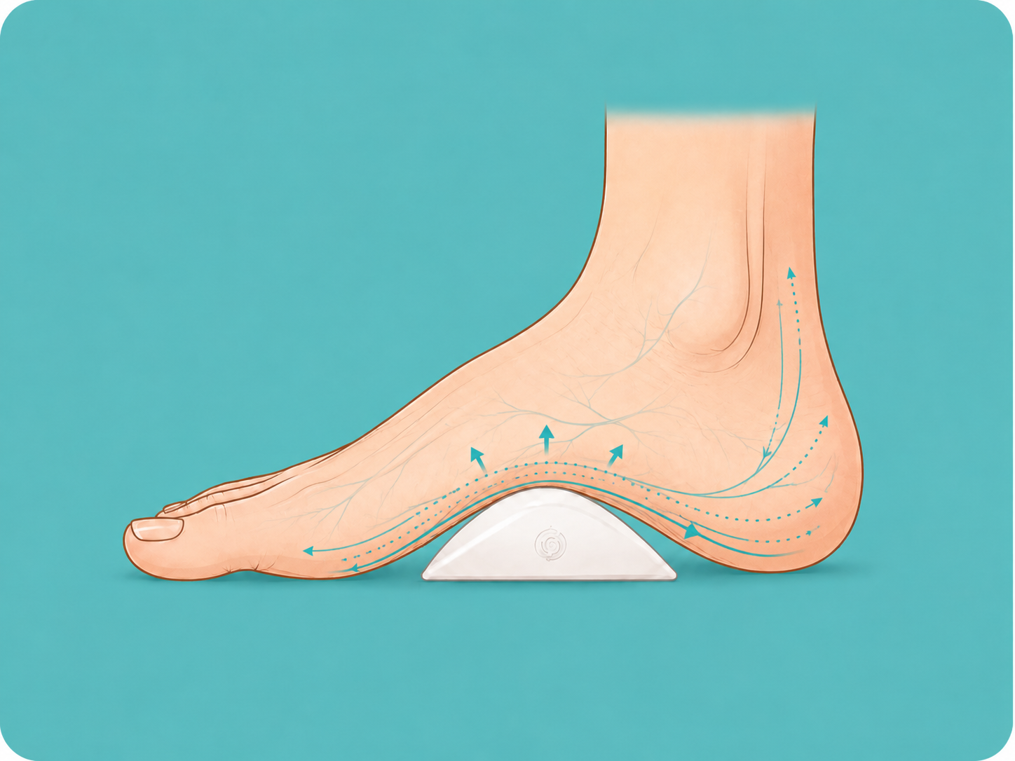 Side view of a foot resting on a Squedgie wedge nested under the medial arch, with adaptive pressure flowing through the midfoot.