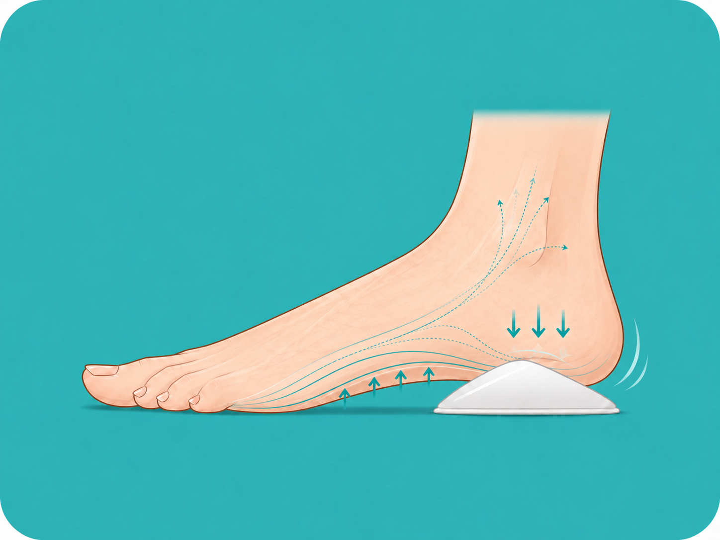 Side view of a foot with a Squedgie wedge under the heel pad, lifting the calcaneus and redistributing weight forward.